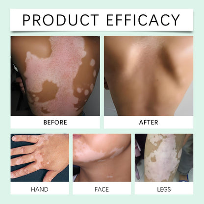 Vitiligo VitaHerb Care™ – Herbal Skin Care Cream