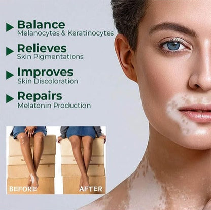 Vitiligo VitaHerb Care™ – Herbal Skin Care Cream